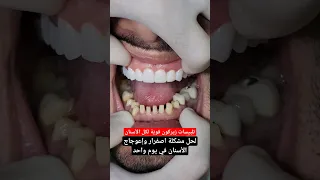 تلبيس اسنان زيركون في يوم واحد