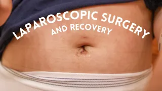 Diagnostic Laparoscopic Surgery and Recovery | Getting Diagnosed with Endometriosis and PCOS |