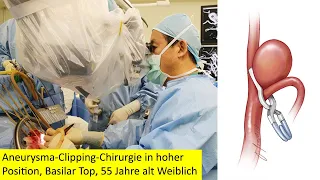 Aneurysma Clipping Chirurgie in hoher Position, Basilar Top, 55 Jahre alt Weiblich