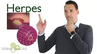 Was ist Herpes? Was hilft? - Gerne Gesund