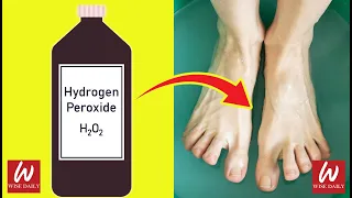 13 Surprising Uses Of Hydrogen Peroxide You Didn't Know | #10 Hydrogen Peroxide Teeth Whitening