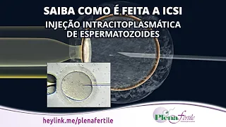 Saiba como é feita a ICSI - Injeção Intracitoplasmática de Espermatozoides