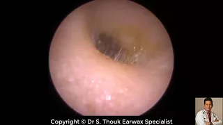 Top Biggest Ear Wax Removal #112 | Ear wax Extraction | Dr. S. Thouk Earwax Specialist