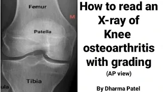 How to read knee joint X-ray in knee osteoarthritis || X-ray anatomy of knee joint