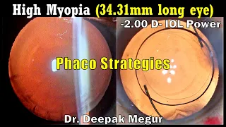 Phacoemulsification Strategies, Senile Cataract with Pathological Myopia - Dr Deepak Megur