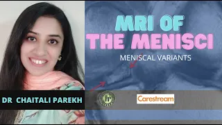 CHAITALI PAREKH | MRI OF MENISCI - MENISCAL VARIANTS