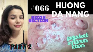 #066 | Part 2 | Begin section | Treatment for severe purulent inflammation for Khanh | Hương Đà Nẵng