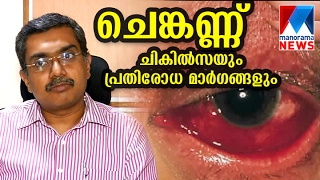 Symptoms and treaments for Conjunctivitis  | Manorama News