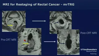 Rectal Cancer MRI: Post Treatment Evaluation-- Gaurav Khatri, MD & Katrina McGinty, MD (SABI '19)