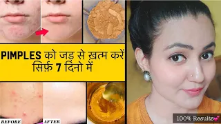 In 7 Days 💕 PIMPLES को जड़ से खत्म करें सिर्फ 7 दिनों में और पाए बेदाग़ Spotless Glowing Skin 100%