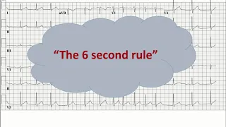 Heart rate in an ECG if rhythm is irregular? II Atrial fibrillation II The 6-second Method