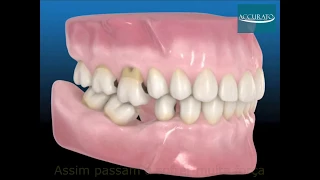 Consequências da perda de um dente