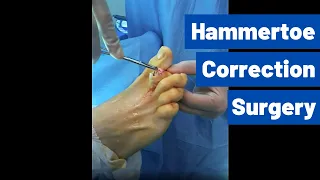 Hammertoe Correction Surgery (Using a 'Smart Toe' Implant) | Moore Foot and Ankle Specialists