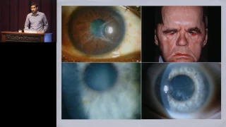 Corneal Dystrophies