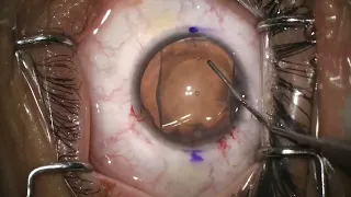 Cirugía de lente intraocular ICL para MIOPÍA y ASTIGMATISMO 🤓