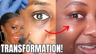 WHOA! My Under Eye Transformation