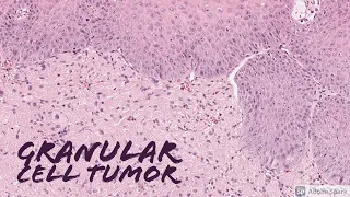 Granular Cell Tumor: 5-Minute Pathology Pearls