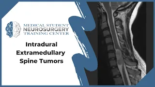 Intradural Extramedullary Spine Tumors