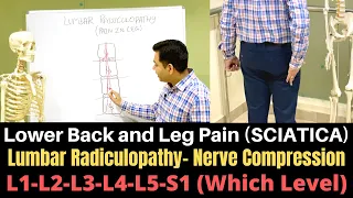 Lumbar Radiculopathy, Sciatica, Lumbar Nerve Root Compression, LOWER BACK and LEG PAIN- Disc Bulge