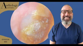 The Ultimate Earwax Removal: A Painstaking Procedure - EP863