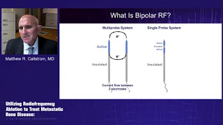 Utilizing Radiofrequency Ablation to Treat Metastatic Bone Disease: A Case-Based Presentation