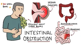 Intestinal Obstruction - Small Bowel Obstruction vs Large Bowel Obstruction