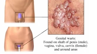 Genital Warts (Condylomata Acuminata)