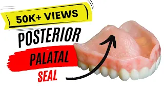 Posterior Palatal Seal (PPS)