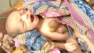 Baby Born With Heart Outside Chest