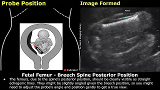 Fetal Femur Ultrasound Probe Positioning & Image Formation | FL USG Scanning Technique & Orientation