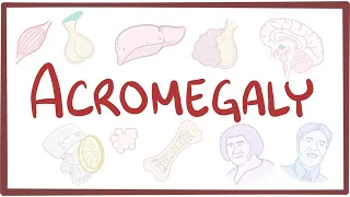 Acromegaly