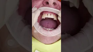 Short Dental implant All on 4 Shorts Prague youtube