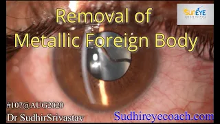 Intraocular Metallic Foreign Body Removal and Management of Traumatic Cataract-DR SUDHIR SRIVASTAV