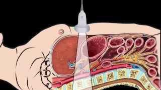 Introduction Abdominal Aorta Focused Ultrasound Examination