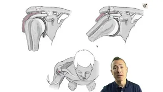 Scapular Dyskinesis | ChiroUp