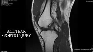 ACL & meniscus tear in sports #sportsinjuryrecovery #ligamentinjury