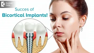 What is the success rates of Bicortical implants? - Dr Samar Mehtab | Doctors' Circle