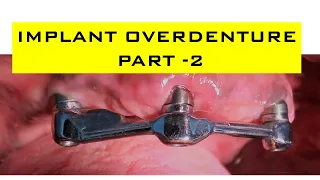 Implant Overdenture Planning - Part 2| Implant Supported Overdenture - Step by Step Planning.