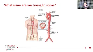 Medical Management of Marfan Syndrome