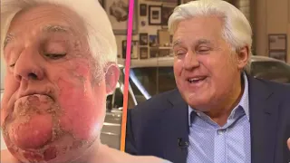 Jay Leno Says His Face Caught Fire in First Interview After Burn Accident