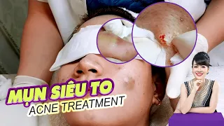 Điều trị mụn nang khổng lồ tại Hiền Vân spa | Cyst Acne Treatment | Trị mụn TPHCM |Đỗ Thu Hiền | 609