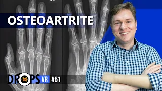 COMO IDENTIFICAR OSTEOARTROSE NO RX?