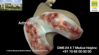 Total Knee Replacement - CIMS Hospital