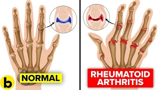 16 Early Warning Signs Of Rheumatoid Arthritis You Might Be Ignoring