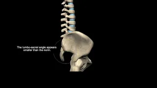 Биомеханика сглаженного лордоза (плоской спины)