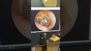 Perforated Eardrum