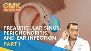 Preauricular Sinus, Perichondritis, and Ear Infection (Part 1) | Usapang Pangkalusugan