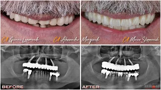 Intra Oral Scan flow,Jig deprogrammer, Michigan Bite, Monolithic Zirconia Toronto bridge