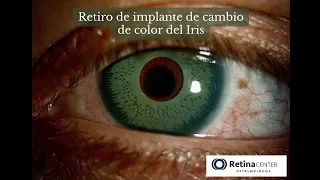 ¿Es peligroso cambiar los ojos de color? | Cirugía de cambio de color de ojos | Iris implant removal