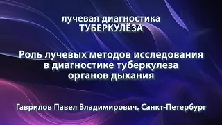 Гаврилов П.В. - Роль лучевых методов исследования в диагностике туберкулеза органов дыхания